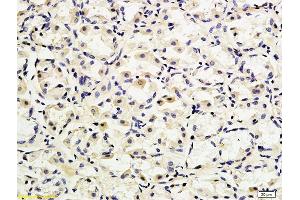 Formalin-fixed and paraffin embedded human gastric adenocarcinoma labeled with Anti-CD162 Polyclonal Antibody, Unconjugated (ABIN679298) followed by conjugation to the secondary antibody