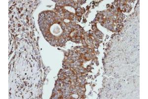 IHC-P Image Immunohistochemical analysis of paraffin-embedded human endo mitral ovarian cancer, using CTSS, antibody at 1:100 dilution. (Cathepsin S antibody)