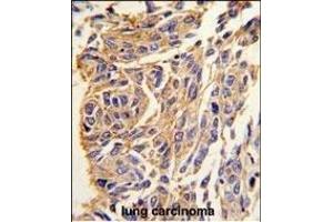 Formalin-fixed and paraffin-embedded human lung carcinoma tissue reacted with T1 antibody (C-term) (ABIN389117 and ABIN2839303) , which was peroxidase-conjugated to the secondary antibody, followed by DAB staining. (PPT1 antibody  (C-Term))
