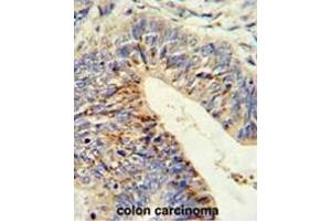 Formalin-fixed and paraffin-embedded human colon carcinoma reacted with ADAMDEC1 Antibody (N-term), which was peroxidase-conjugated to the secondary antibody, followed by DAB staining. (ADAMDEC1 antibody  (N-Term))