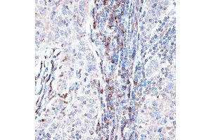 Immunohistochemistry of paraffin-embedded human esophageal cancer using DCP1A Rabbit mAb (ABIN7266678) at dilution of 1:100 (40x lens). (DCP1A antibody)