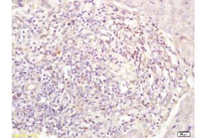 Formalin-fixed and paraffin embedded human breast carcinoma labeled with Anti-STK38 Polyclonal Antibody, Unconjugated (ABIN716471) at 1:200 followed by conjugation to the secondary antibody (STK38 antibody  (AA 31-130))