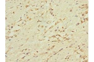 Immunohistochemistry of paraffin-embedded human gastric cancer using ABIN7158286 at dilution of 1:100 (CD53 antibody  (AA 100-180))