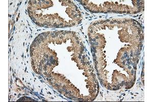 Immunohistochemical staining of paraffin-embedded Adenocarcinoma of Human ovary tissue using anti-BCL10 mouse monoclonal antibody. (BCL10 antibody)