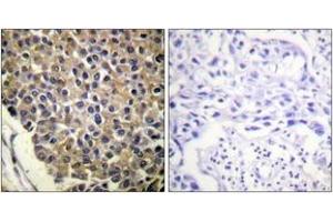 Immunohistochemistry analysis of paraffin-embedded human breast carcinoma, using IL-8R beta/CDw128 beta (Phospho-Ser347) Antibody. (CXCR2 antibody  (pSer347))