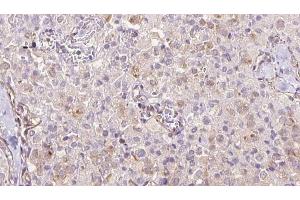 ABIN6273333 at 1/100 staining Human thyroid cancer tissue by IHC-P. (TRAPPC9 antibody  (Internal Region))