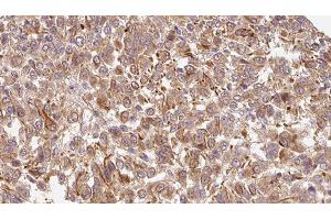 ABIN6278211 at 1/100 staining Human Melanoma tissue by IHC-P. (Biglycan antibody  (C-Term))