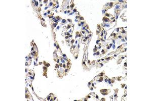Immunohistochemistry of paraffin-embedded human lung cancer using VEGFD antibody (ABIN5970538) at dilution of 1/200 (40x lens).