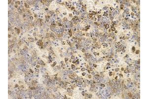 ABIN6256218 and ABIN6267659 at 1/100 staining human melanoma by IHC-P. (SMAD2 antibody  (pSer250))