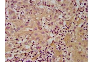 IHC image of ABIN7143530 diluted at 1:600 and staining in paraffin-embedded human liver cancer performed on a Leica BondTM system. (NUDT5 antibody  (AA 34-166))