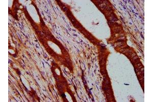 IHC image of ABIN7169209 diluted at 1:400 and staining in paraffin-embedded human colon cancer performed on a Leica BondTM system. (ULK2 antibody  (AA 211-276))