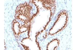 Formalin-fixed, paraffin-embedded human Prostate Carcinoma stained with NKX3. (NKX3-1 antibody  (AA 92-224))