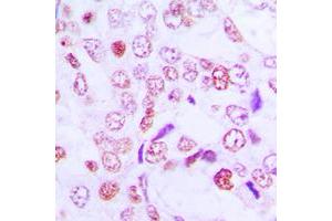 Immunohistochemical analysis of Cyclin G1 staining in human lung cancer formalin fixed paraffin embedded tissue section. (Cyclin G1 antibody  (Center))