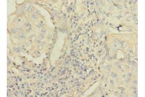 Immunohistochemistry of paraffin-embedded human lung cancer using ABIN7146164 at dilution of 1:100 (C4BPA antibody  (AA 49-597))