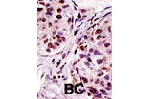 Formalin-fixed and paraffin-embedded human cancer tissue reacted with HGS polyclonal antibody  , which was peroxidase-conjugated to the secondary antibody, followed by AEC staining . (HGS antibody  (N-Term))