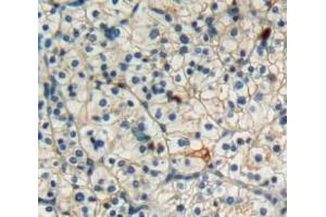 Used in DAB staining on fromalin fixed paraffin-embedded kidney cancer tissue (FAS antibody  (AA 21-170))