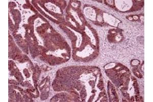 Immunohistochemistry of humen colon cancer with LARS polyclonal antibody . (LARS antibody)