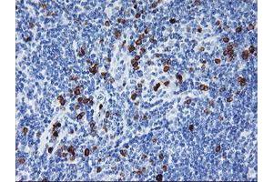 Immunohistochemical staining of paraffin-embedded Human lymphoma tissue using anti-IGJ mouse monoclonal antibody. (IGJ antibody)