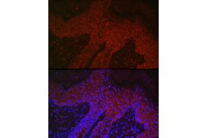 Immunofluorescence analysis of human skin cancer using DKK2 Rabbit pAb (ABIN7266756) at dilution of 1:400 (40x lens). (DKK2 antibody  (C-Term))