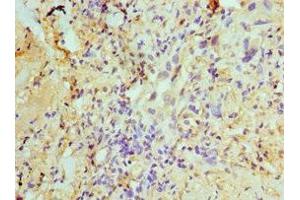 Immunohistochemistry of paraffin-embedded human lung cancer using ABIN7170632 at dilution of 1:100 (U2AF1 antibody  (AA 1-240))