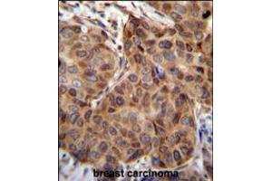 SNX24 Antibody immunohistochemistry analysis in formalin fixed and paraffin embedded human breast carcinoma followed by peroxidase conjugation of the secondary antibody and DAB staining. (SNX24 antibody  (N-Term))