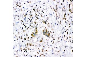 Anti- NR3C1 antibody,IHC(P) IHC(P): Human Mammary Cancer Tissue (Glucocorticoid Receptor antibody  (AA 1-373))