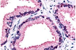 Immunohistochemical (Formalin/PFA-fixed paraffin-embedded sections) staining in human prostate, epithelium with GPR87 polyclonal antibody . (GPR87 antibody  (C-Term))