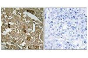 Immunohistochemistry analysis of paraffin-embedded human breast carcinoma tissue, using BTBD6 antibody. (BTBD6 antibody)
