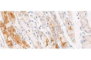 Immunohistochemistry of paraffin-embedded Human gastric cancer tissue using NDUFB7 Polyclonal Antibody at dilution of 1:35(x200)