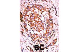 Formalin-fixed and paraffin-embedded human breast cancer tissue reacted with ERBB2 (phospho Y1248) polyclonal antibody  which was peroxidase-conjugated to the secondary antibody followed by AEC staining.