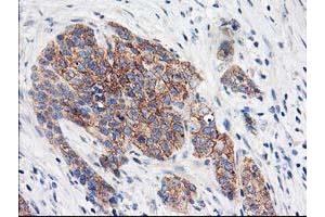 Immunohistochemical staining of paraffin-embedded Adenocarcinoma of Human breast tissue using anti-EIF2B3 mouse monoclonal antibody.