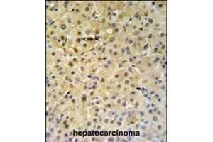 PSME1 Antibody IHC analysis in formalin fixed and paraffin embedded hepatocarcinoma followed by peroxidase conjugation of the secondary antibody and DAB staining. (PSME1 antibody  (C-Term))