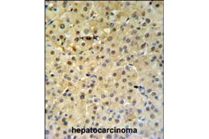 PSME1 Antibody IHC analysis in formalin fixed and paraffin embedded hepatocarcinoma followed by peroxidase conjugation of the secondary antibody and DAB staining.