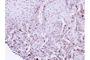 IHC-P Image Immunohistochemical analysis of paraffin-embedded Cal27 xenograft, using TACC2, antibody at 1:100 dilution. (TACC2 antibody  (N-Term))