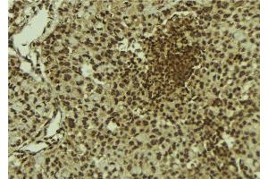 ABIN6278768 at 1/100 staining Human breast cancer tissue by IHC-P. (KAT6B antibody  (C-Term))