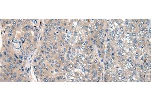 Immunohistochemistry of paraffin-embedded Human liver cancer tissue using CLTCL1 Polyclonal Antibody at dilution of 1:60(x200)