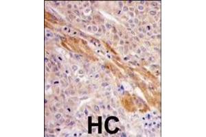 Formalin-fixed and paraffin-embedded human hepatocarcinoma tissue reacted with PGK1 Antibody (Center ) (ABIN391250 and ABIN2837966) , which was peroxidase-conjugated to the secondary antibody, followed by DAB staining. (PGK1 antibody  (AA 305-334))
