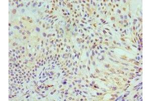Immunohistochemistry of paraffin-embedded human breast cancer using ABIN7150341 at dilution of 1:100 (MCM7 antibody  (AA 360-719))
