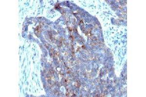 Formalin-fixed, paraffin-embedded human ovarian carcinoma stained with RBP1 (RBP/872)
