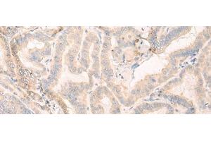 Immunohistochemistry of paraffin-embedded Human thyroid cancer tissue using SEPT10 Polyclonal Antibody at dilution of 1:25(x200) (Septin 10 antibody)