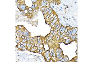 Immunohistochemistry of paraffin-embedded human liver cancer using SLC22/OCT3 Rabbit mAb (ABIN7269107) at dilution of 1:100 (40x lens). (SLC22A3 antibody)