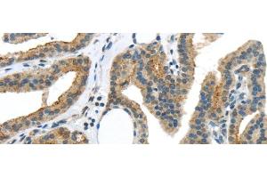 Immunohistochemistry of paraffin-embedded Human thyroid cancer using VAMP2 Polyclonal Antibody at dilution of 1/40 (VAMP2 antibody)