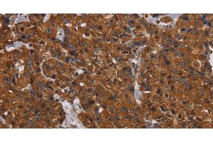 Immunohistochemistry of paraffin-embedded Human breast cancer tissue using HYAL2 Polyclonal Antibody at dilution 1:60