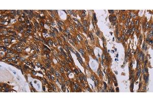 Immunohistochemistry of paraffin-embedded Human colon cancer using KARS Polyclonal Antibody at dilution of 1:60 (KARS antibody)