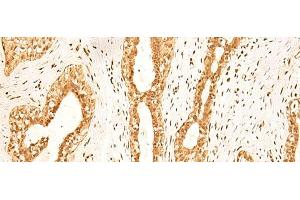 Immunohistochemistry of paraffin-embedded Human breast cancer tissue using ZNF471 Polyclonal Antibody at dilution of 1:50(x200) (ZNF471 antibody)