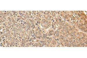 Immunohistochemistry of paraffin-embedded Human liver cancer tissue using BRF2 Polyclonal Antibody at dilution of 1:40(x200)