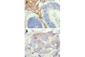 Immunohistochemical analysis of paraffin-embedded human colon cancer (A) and breast cancer (B) showing cytoplasmic localization with DAB staining using FBLN5 monoclonal antibody, clone 1G6A4 .
