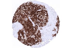 Hepatocellular carcinoma showing strong nuclear and cytoplasmic arginase 1 positivity in all tumor cells (Recombinant Liver Arginase antibody  (AA 300-400))