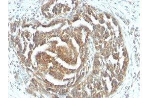 Formalin-fixed, paraffin-embedded human Ovarian Carcinoma stained with VEGF Mouse Monoclonal Antibody (VEGF/1063).
