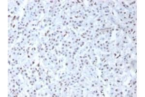 Formalin-fixed, paraffin-embedded human Mesothelioma stained with Wilm's Tumor Rabbit Polyclonal Antibody Antibody. (WT1 antibody)